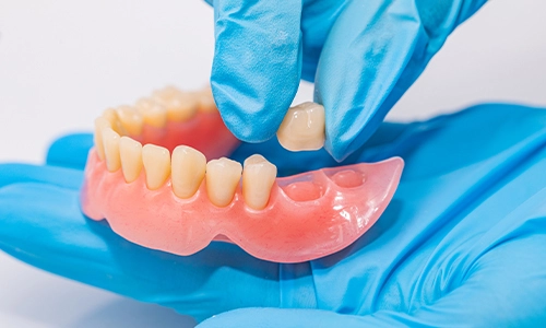 Cómo los dientes de la dentadura artificial mejoran la calidad de vida